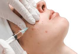 Acne treatment consultation