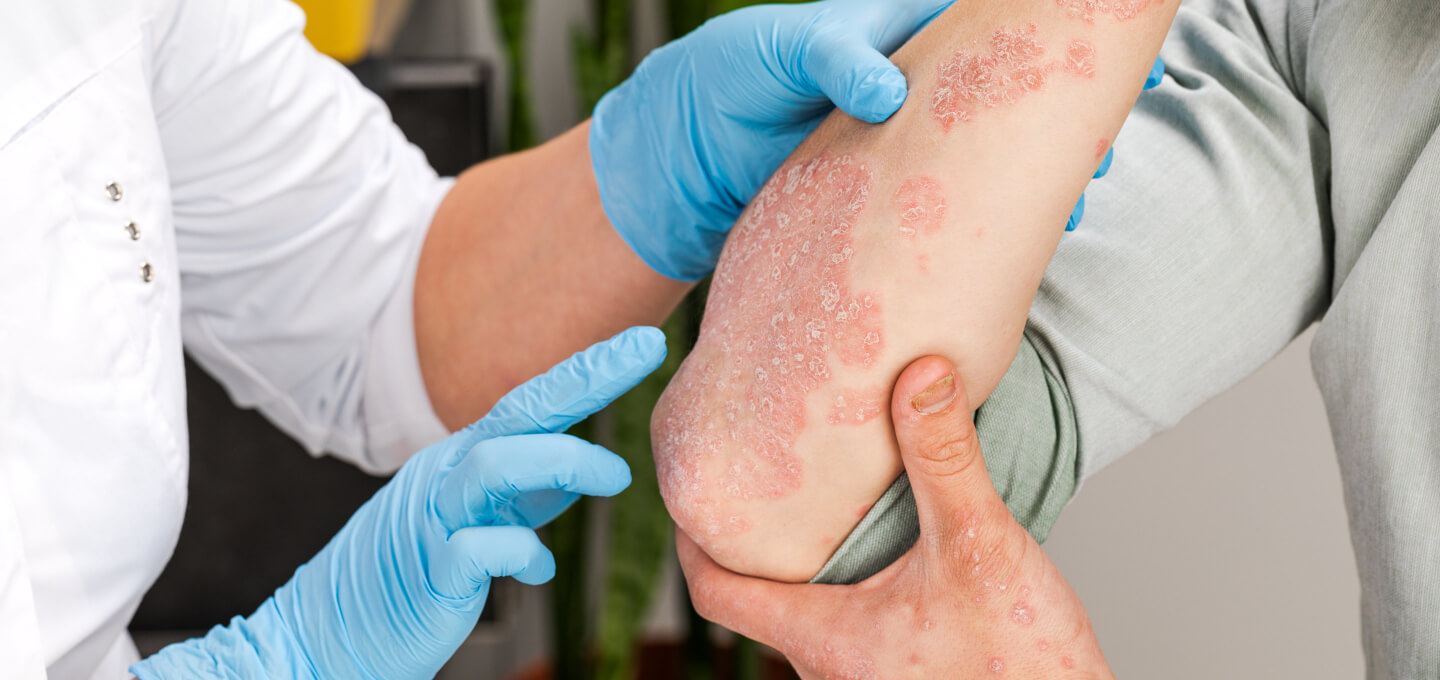 Psoriasis treatment consultation